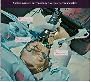 Surviving the Nightmare: Massive Bleeding From Large Intraoral Arteriovenous Malformation During Airway Management for Angioembolization Procedure.
