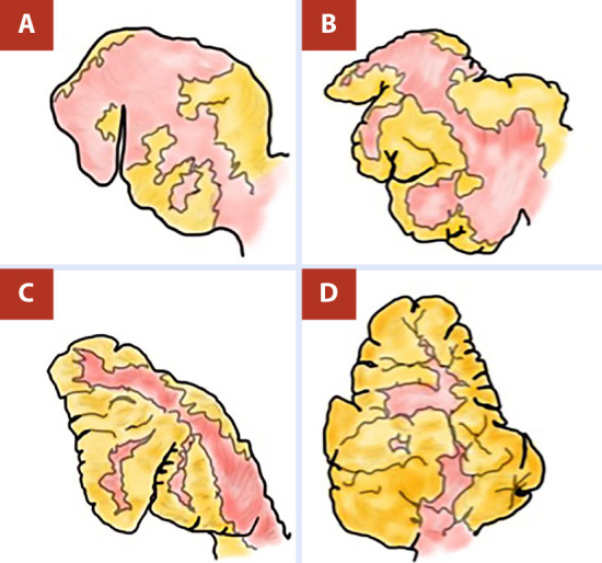 [Surgical closure of the left atrial appendage in cardiac surgery: a review article].