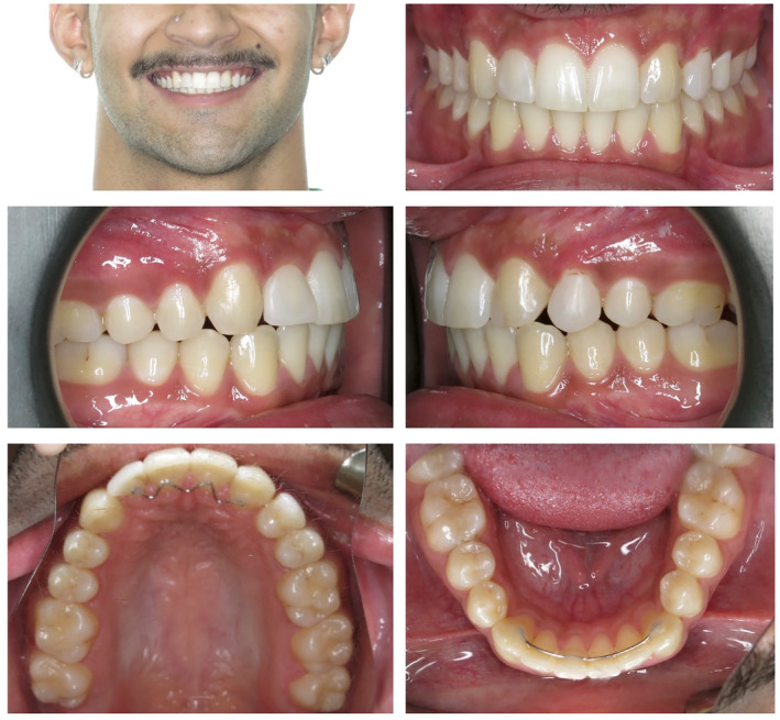 Conservative interdisciplinary management for a congenitally missing maxillary lateral incisor in an adolescent patient.