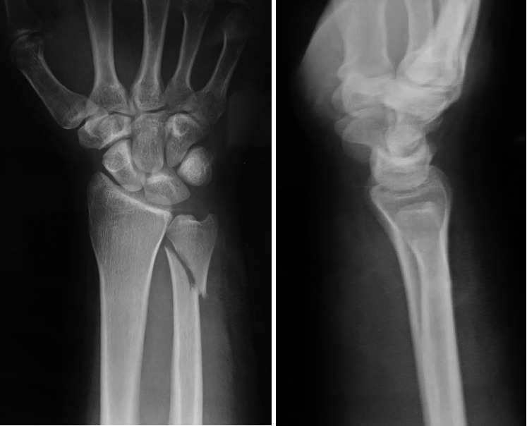 Internal Fixation for Unstable Distal Ulnar Fractures by 2.7 mm Semitubular Hook Plate.