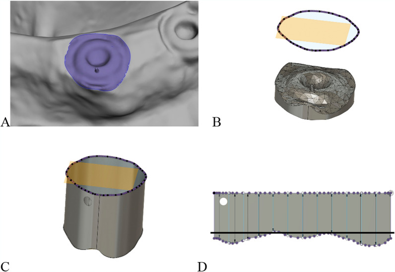 Novel digital technique for assessing circumferential peri-implant bone height.