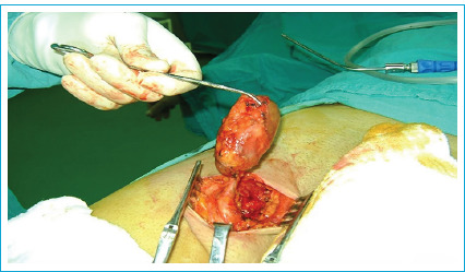 An Underappreciated Etiology of Groin Mass: Great Saphenous Vein Aneurysm.