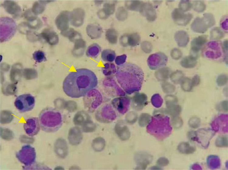 <i>CSF3R</i> Gln776X and <i>ASXL1</i> mutations in multiple myeloma associated with chronic neutrophilic leukemia: case report and literature review.