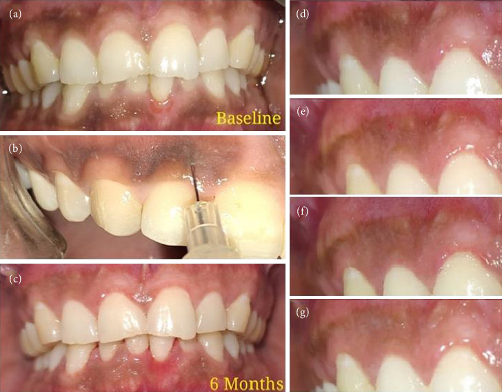 Vitamin C-Based Gingival Depigmentation Versus Surgical Depigmentation: A Randomized Clinical Trial.