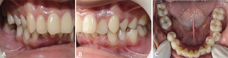 A study to evaluate the influence of non-axial forces on tooth - a split mouth cross-sectional study.