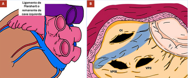[Surgical closure of the left atrial appendage in cardiac surgery: a review article].