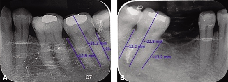 A study to evaluate the influence of non-axial forces on tooth - a split mouth cross-sectional study.