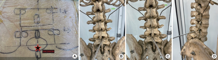 Full-Endoscopic Midline Foraminoplasty: An Alternative Method for Treating Lumbar Foraminal Stenosis.