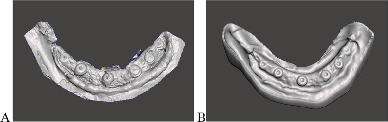 Novel digital technique for assessing circumferential peri-implant bone height.