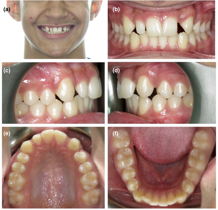 Conservative interdisciplinary management for a congenitally missing maxillary lateral incisor in an adolescent patient.