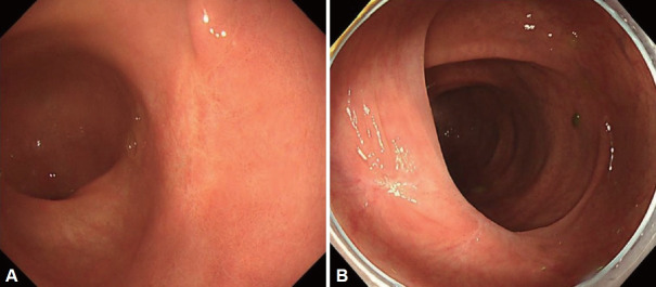 Gastric Subepithelial Lesion Accompanied by Colonic Subepithelial Mass.