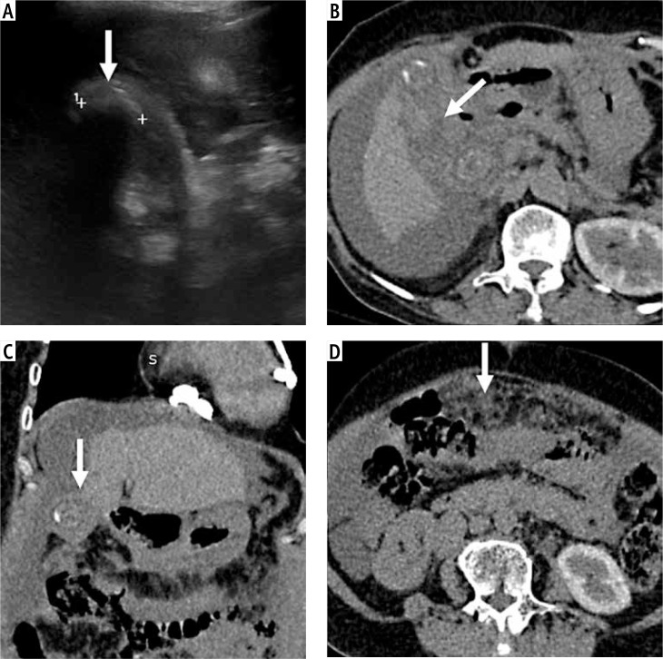 Deep learning-based classification of gallbladder lesions in patients with non-diagnostic (GB-RADS 0) ultrasound.