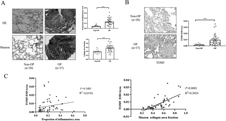 TOM5 regulates the mitochondrial membrane potential of alveolar epithelial cells in organizing pneumonia.