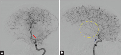 Moyamoya disease manifesting with bilateral involvement of the proximal vertebral arteries: A case report.