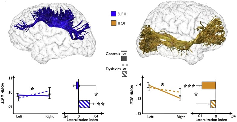 A decade of white matter connectivity studies in developmental dyslexia.