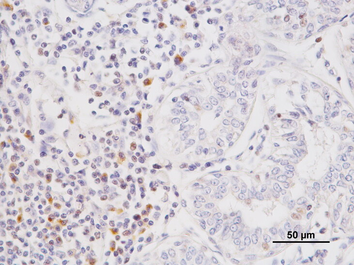TGFβ in malignant canine mammary tumors: relation with angiogenesis, immunologic markers and prognostic role.