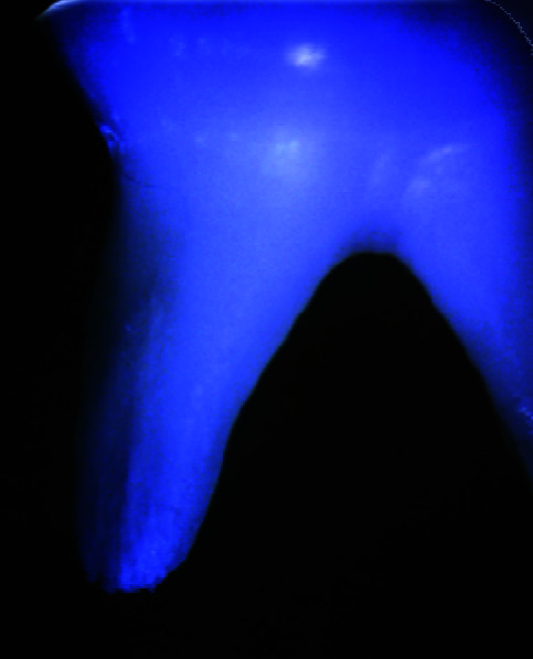 Comparative Evaluation of Crack Propagation During Root Canal Preparation in Primary Molar with Manual Instrumentation, ProTaper Universal and ProTaper Next Rotary File Systems: An <i>in vitro</i> Study.