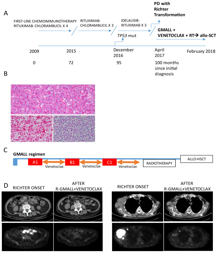 Venetoclax Plus Intensified Chemoimmunotherapy as a Bridge to Allogeneic Stem Cell Transplantation in Richter Syndrome: Report of Two Cases.