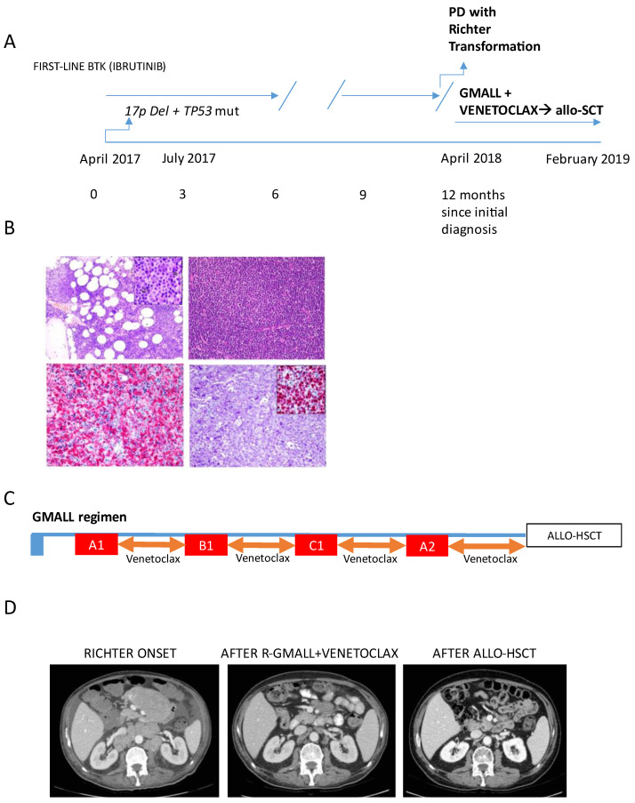 Venetoclax Plus Intensified Chemoimmunotherapy as a Bridge to Allogeneic Stem Cell Transplantation in Richter Syndrome: Report of Two Cases.