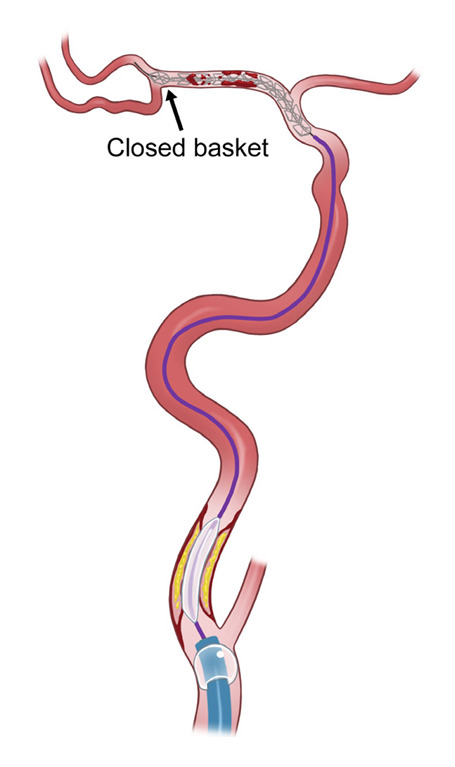 Novel use of a stent retriever as a distal filler protection device for prevention of secondary embolization.