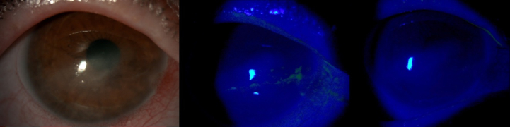 Long-term Results of Topical Insulin Treatment for Persistent Corneal Epithelial Defects.