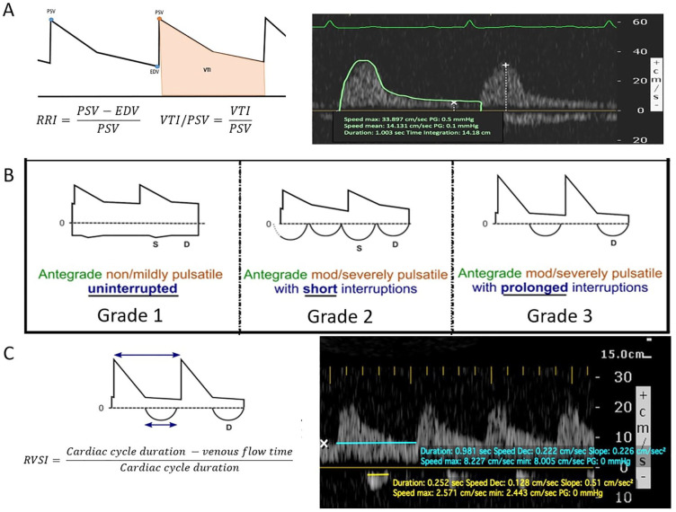 Prediction of Acute Kidney Injury After Cardiac Surgery With Combined Arterial and Venous Intrarenal Doppler.