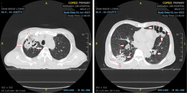 Lemierre's Syndrome Due to <i>Klebsiella pneumoniae</i> Results in Pulmonary Abscess Complications in a Patient With Diabetes: A Rare Case Report.