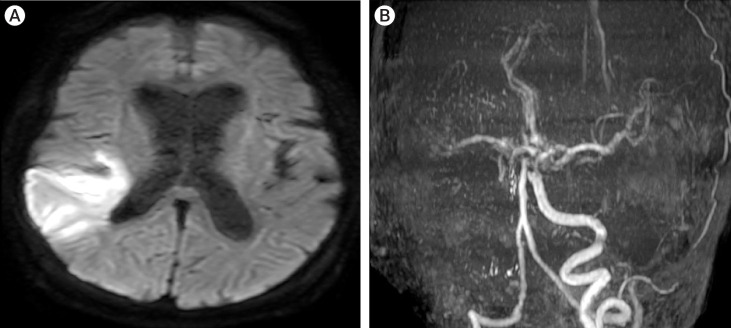 Novel use of a stent retriever as a distal filler protection device for prevention of secondary embolization.