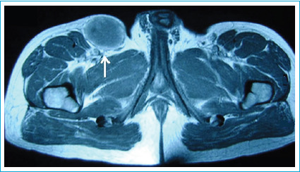 An Underappreciated Etiology of Groin Mass: Great Saphenous Vein Aneurysm.