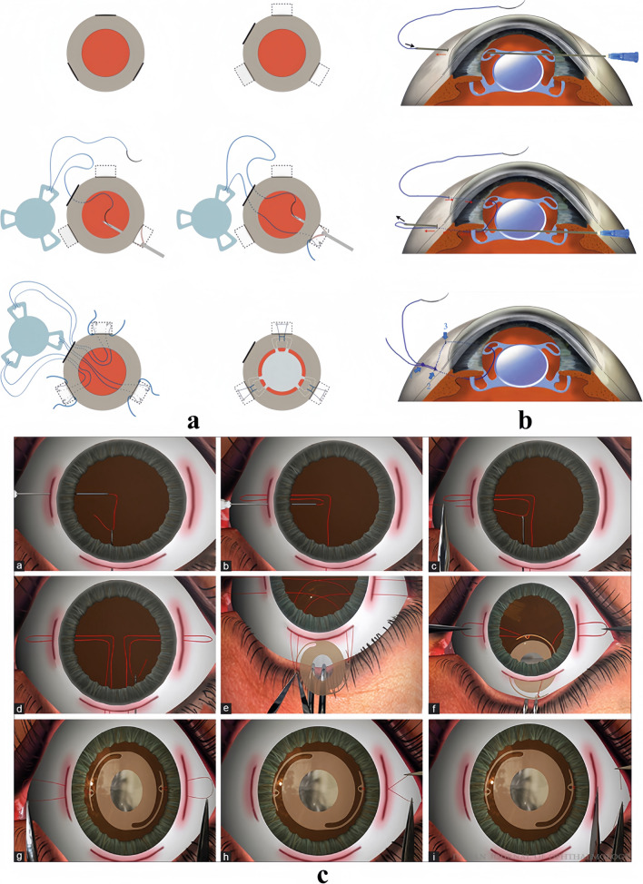 Recent advances and current challenges in suture and sutureless scleral fixation techniques for intraocular lens: a comprehensive review.