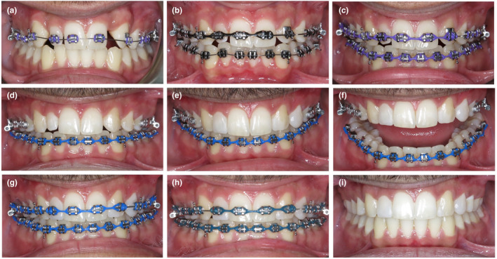 Conservative interdisciplinary management for a congenitally missing maxillary lateral incisor in an adolescent patient.