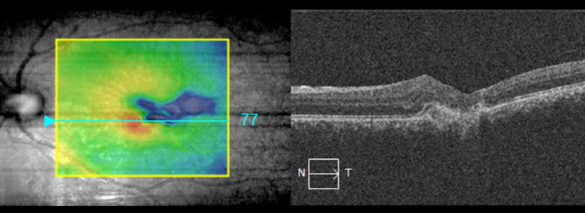 An Unusual Case of Low Vision and Anisocoria Considered a Neurological Finding in the Emergency Department: Ocular Siderosis.