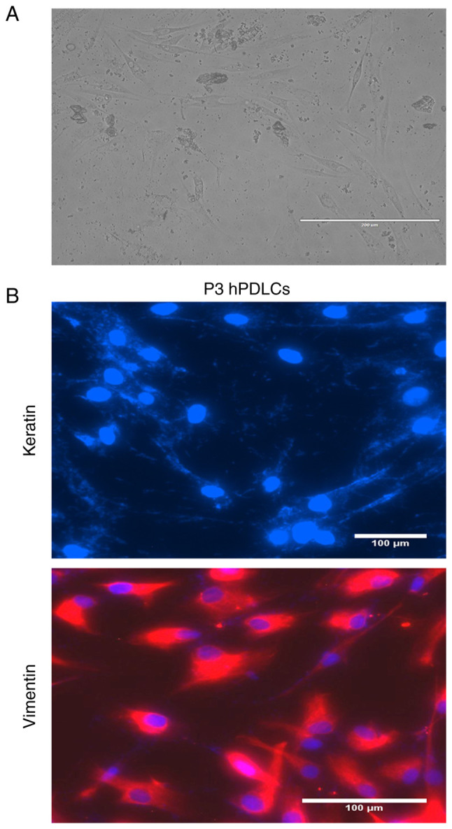 Effect of overexpression of <i>GRN</i> on the proliferation and osteogenic capacity of human periodontal cells.