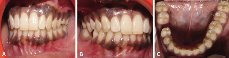 A study to evaluate the influence of non-axial forces on tooth - a split mouth cross-sectional study.