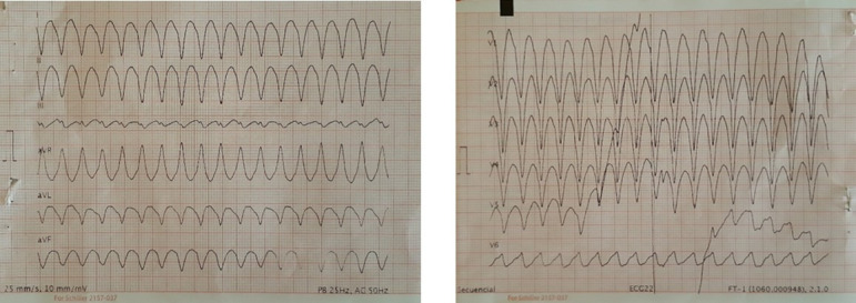 Sustained Ventricular Tachycardia as the first presentation of transthyretin amyloid cardiomyopathy.