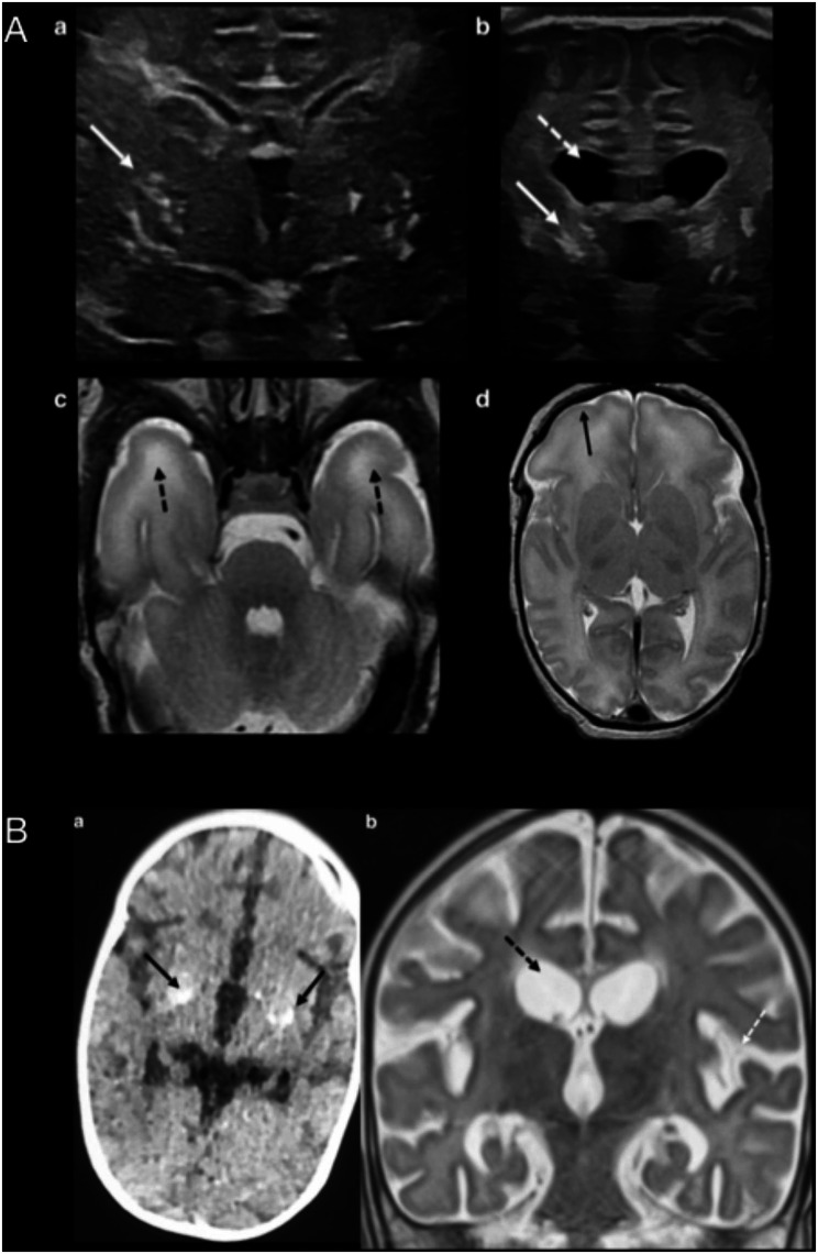 Aicardi-Goutières syndrome type 6: report of ADAR variant and clinical outcome after ruxolitinib treatment in the neonatal period.
