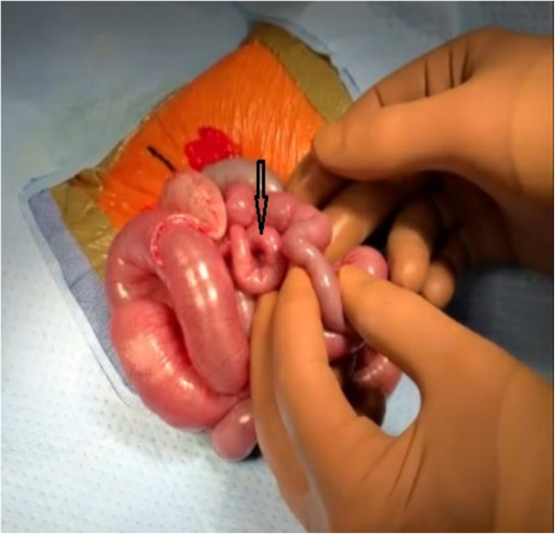 Persistent abdominal distension, bilious emesis, and feeding intolerance in an infant without anatomical bowel obstruction.