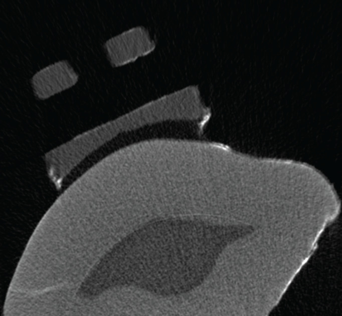 Evaluation of Microleakage in Flash-Free and Conventional Ceramic Brackets: A Microcomputed Tomography Study.
