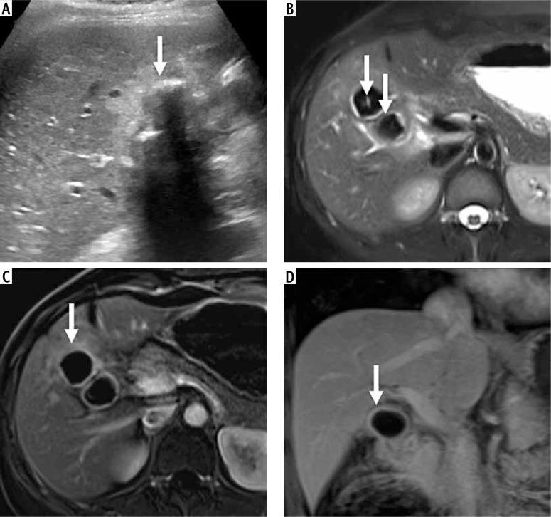 Deep learning-based classification of gallbladder lesions in patients with non-diagnostic (GB-RADS 0) ultrasound.