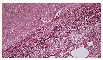An Underappreciated Etiology of Groin Mass: Great Saphenous Vein Aneurysm.