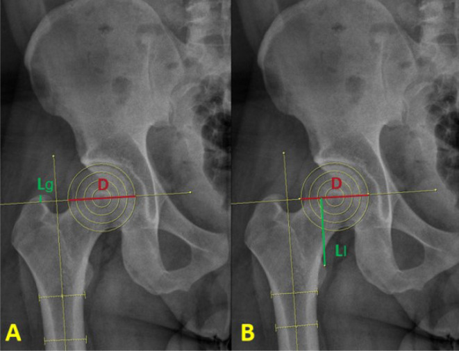 Greater Trochanter Tip as an Anatomical Reference to Minimize Leg Length Discrepancy following Hip Arthroplasty.