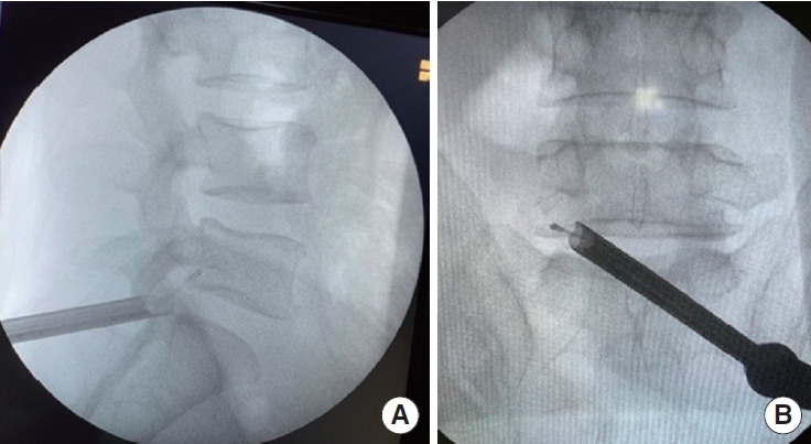 Full-Endoscopic Midline Foraminoplasty: An Alternative Method for Treating Lumbar Foraminal Stenosis.