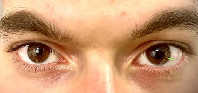 An Unusual Case of Low Vision and Anisocoria Considered a Neurological Finding in the Emergency Department: Ocular Siderosis.