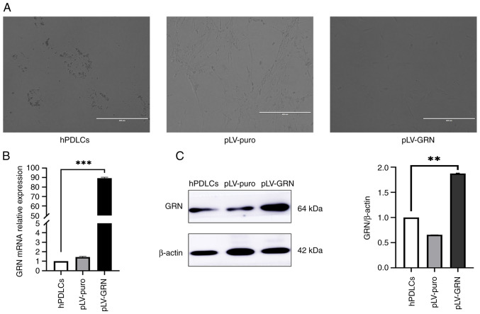 Effect of overexpression of <i>GRN</i> on the proliferation and osteogenic capacity of human periodontal cells.