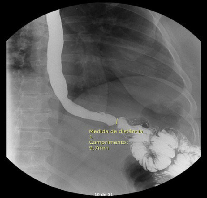 CLINICAL RELEVANCE OF ESOPHAGEAL MOTILITY DISORDERS AFTER BARIATRIC SURGERY: A PROSPECTIVE STUDY BASED ON HIGH-RESOLUTION IMPEDANCE MANOMETRY.
