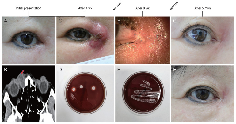 Chronic Mycobacterium abscessus Dacryocystitis after Endoscopic Dacryocystorhinostomy: A Case Report.