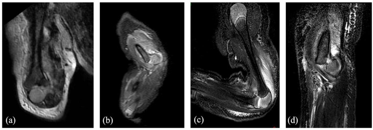 Management of the supposed elbow dislocation in newborns.
