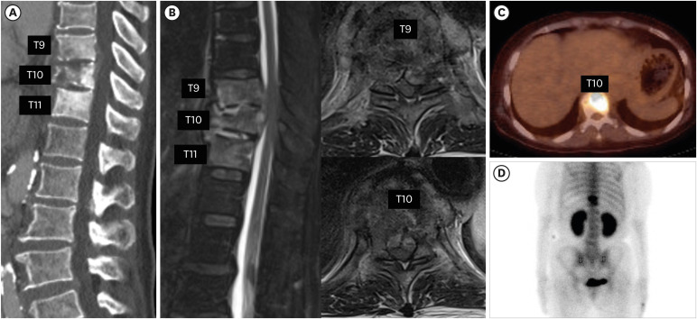 Spinal Cord Injury From Tuberculous Spondylitis Misdiagnosed as Metastatic Spinal Tumor and Bacterial Spondylitis: A Case Report & Literature Review.