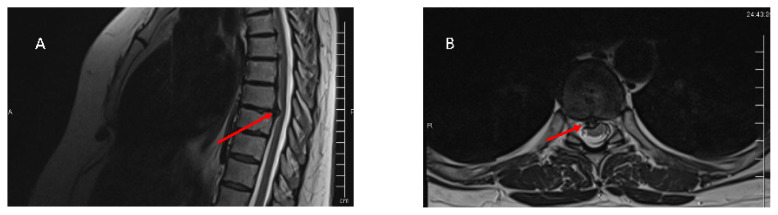 Thoracic disc herniations: diagnosis, surgical techniques, and complication insights.