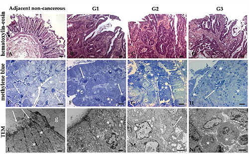 High WTAP expression level as a promising biomarker for poor prognosis in colorectal cancer: a pilot study.